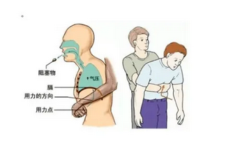 遇到异物卡住喉咙，可采取海姆立克急救法。海姆立克急救法是科学解除气道异物堵塞的急救方法，分为成人版操作和儿童版操作两种急救方法(图1)
